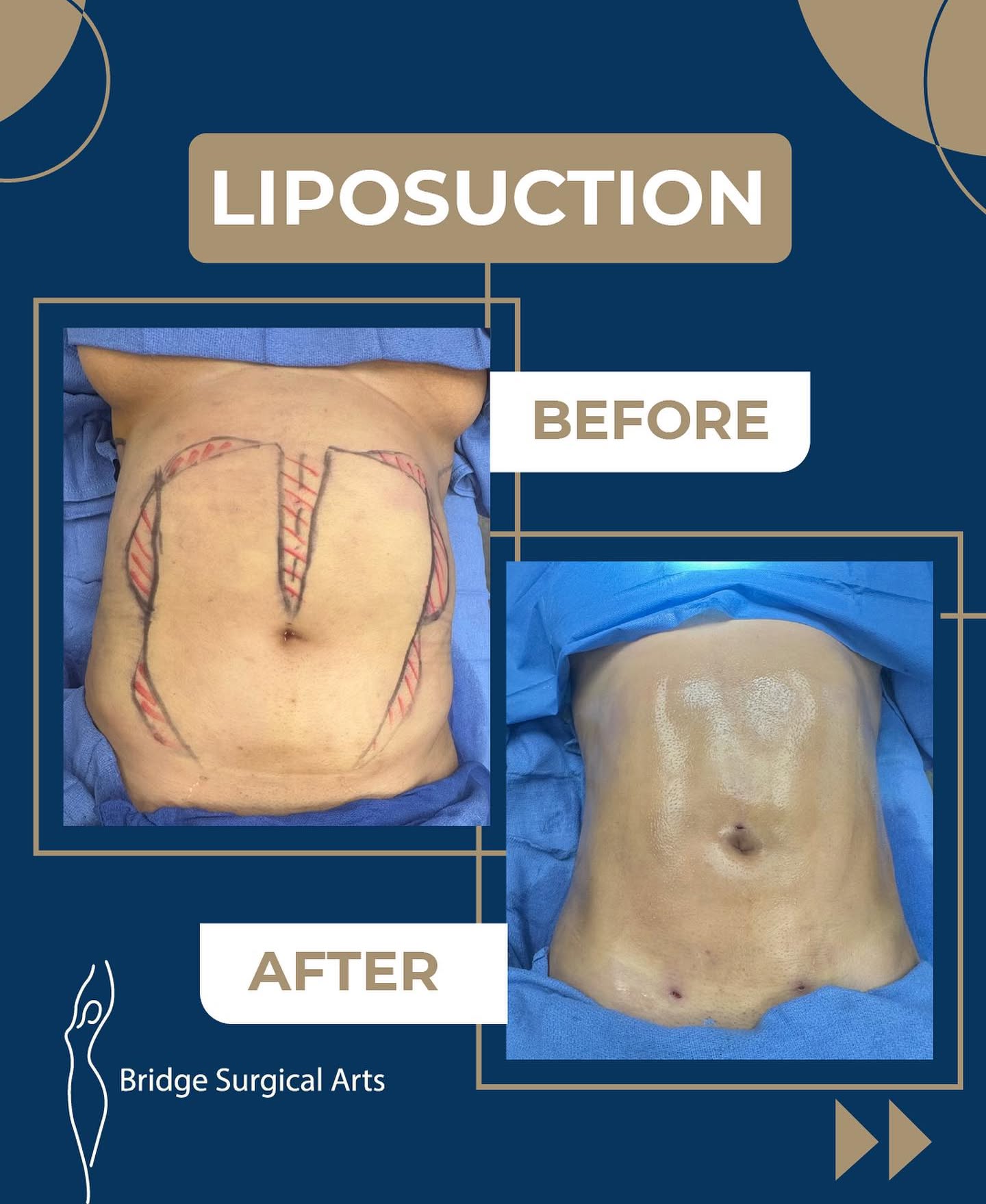 Before and after result 3